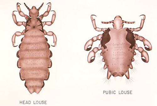 Gambar jelas menunjukkan perbezaan antara kepala dan kutu kemaluan.