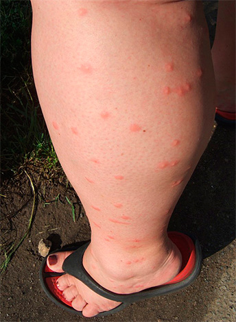 Titik merah kecil di kaki - banyak gigitan kutu.