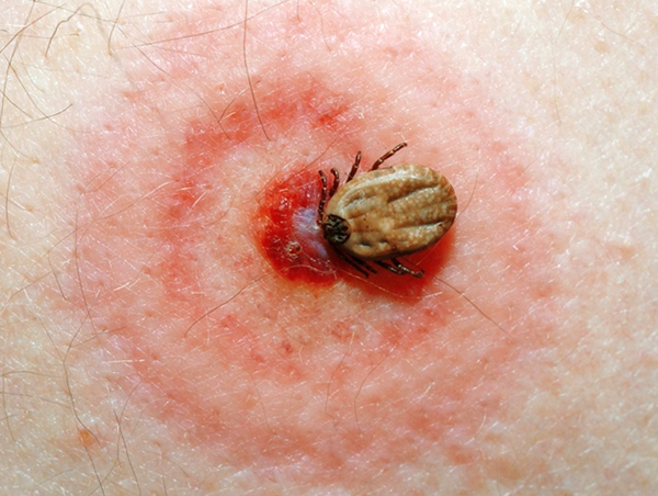 Sempadan merah ciri di beberapa cincin di sekitar tapak gigitan adalah salah satu tanda jelas borreliosis bawaan kutu.