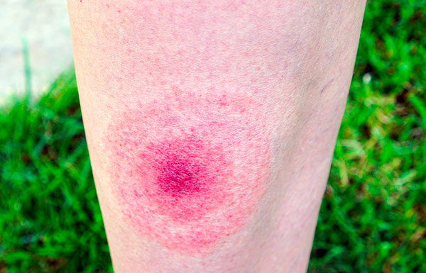 Erythema dalam borreliosis adalah salah satu tanda penyakit